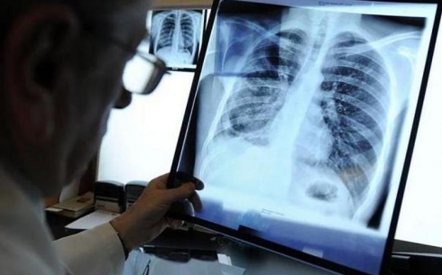 Жители балхашского региона стали реже болеть туберкулезом