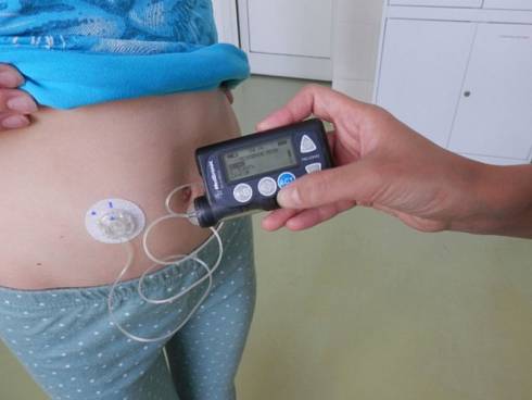 Список нуждающихся в инсулиновых помпах детей создадут в Казахстане