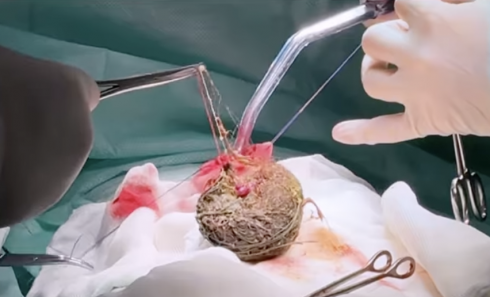 Комок волос и ниток извлекли карагандинские хирурги из желудка ребенка