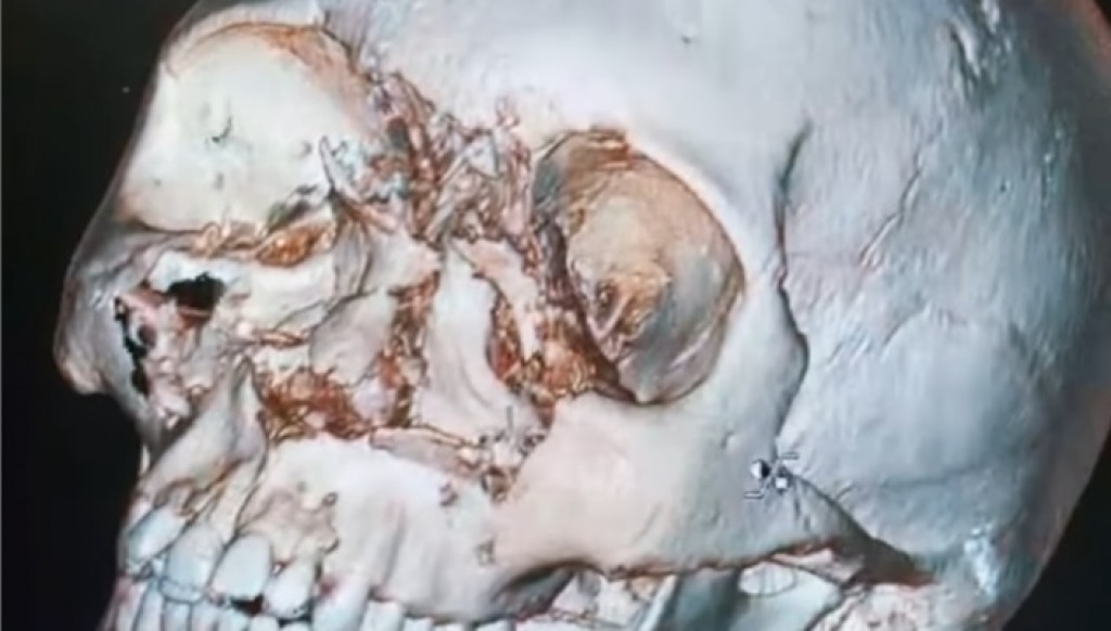 Сложную операцию ребёнку с повреждением костей лица провели карагандинские медики