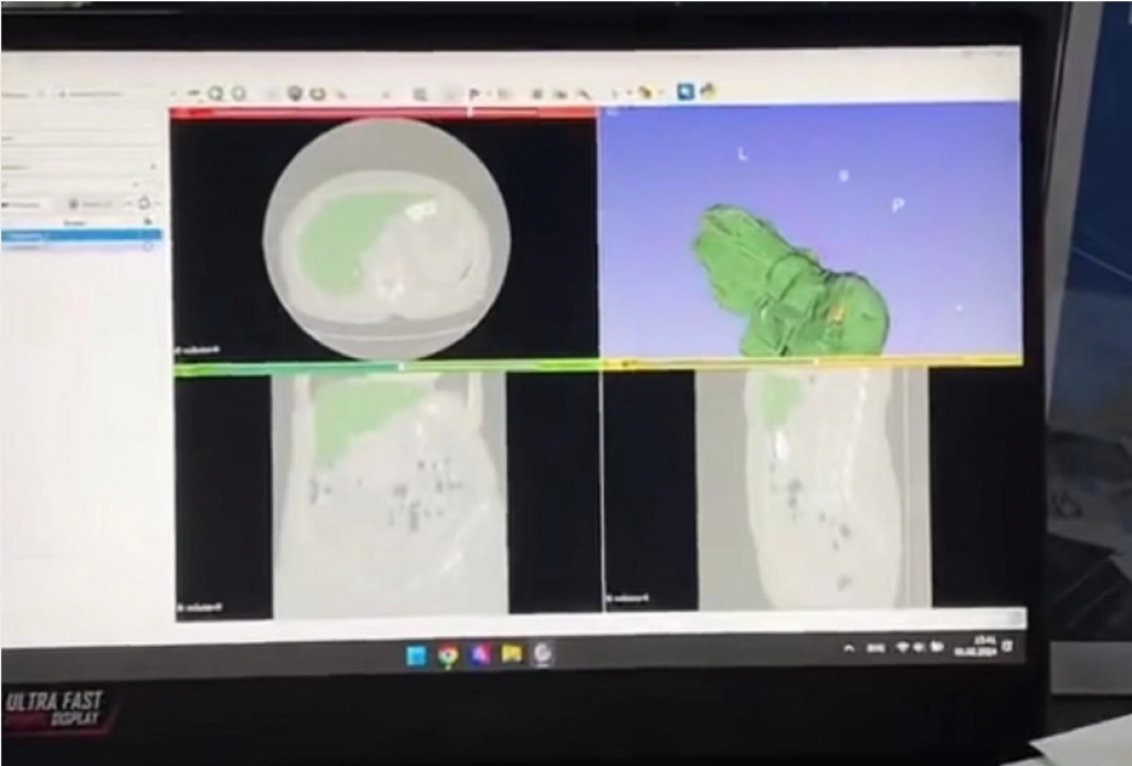 Карагандинские айтишники научились выявлять рак за 7 минут, но не заинтересовали государство