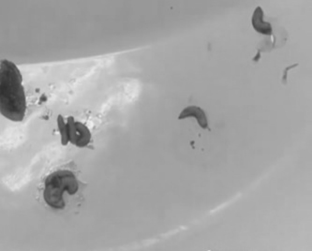 Более десяти живых червей извлекли медики из носа двухлетней девочки в Караганде