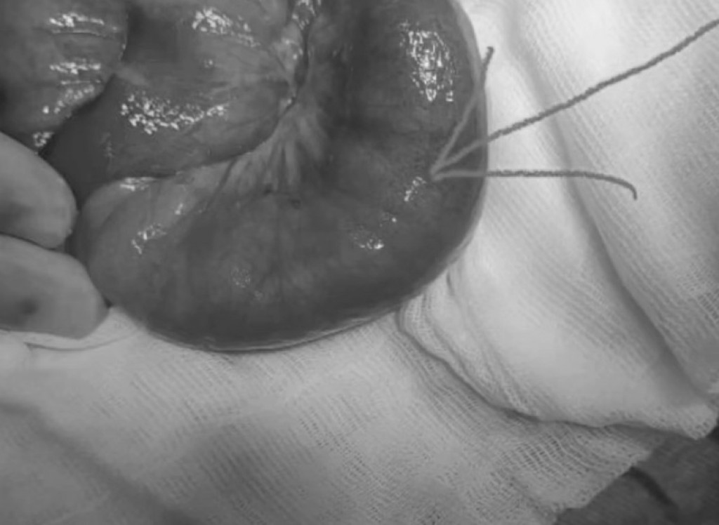 В Караганде медики извлекли комок волос из кишечника 13-летней девочки