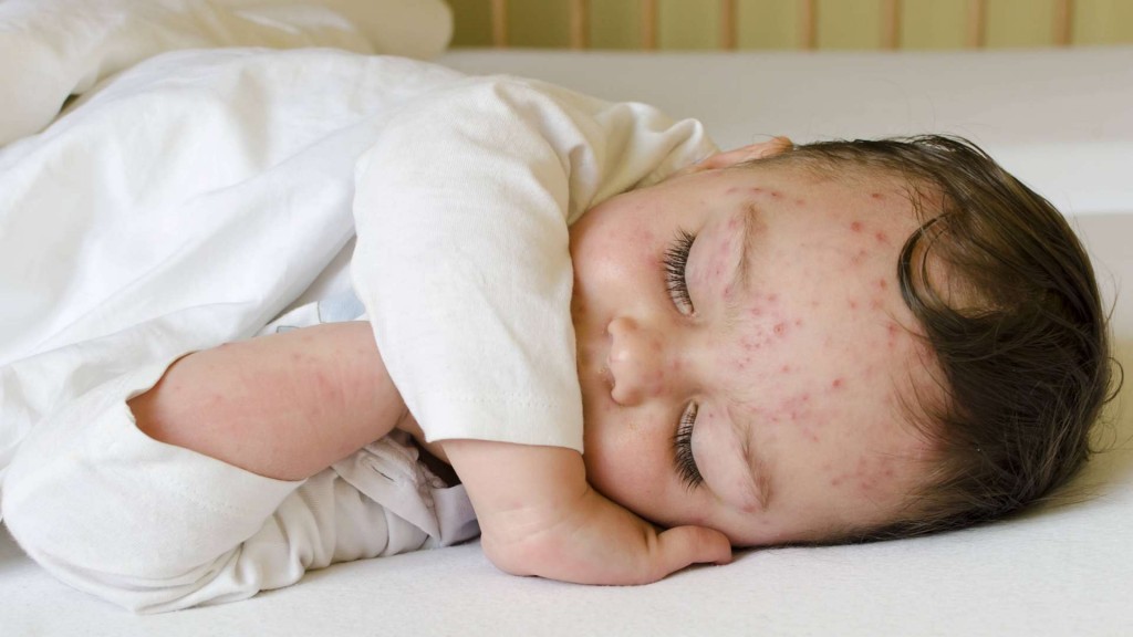 В Карагандинской области летальных случаев от кори не зарегистрировано