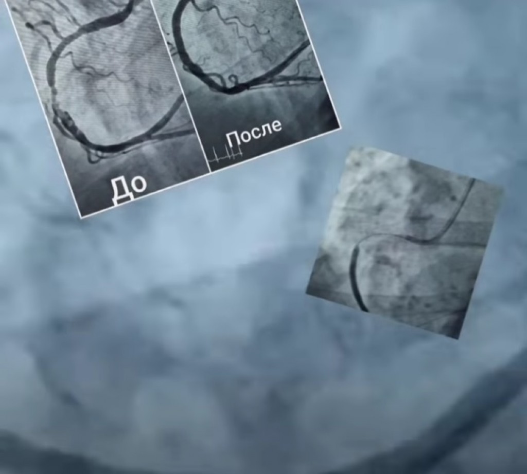 Экстренную операцию провели 92-летнему пациенту в Караганде