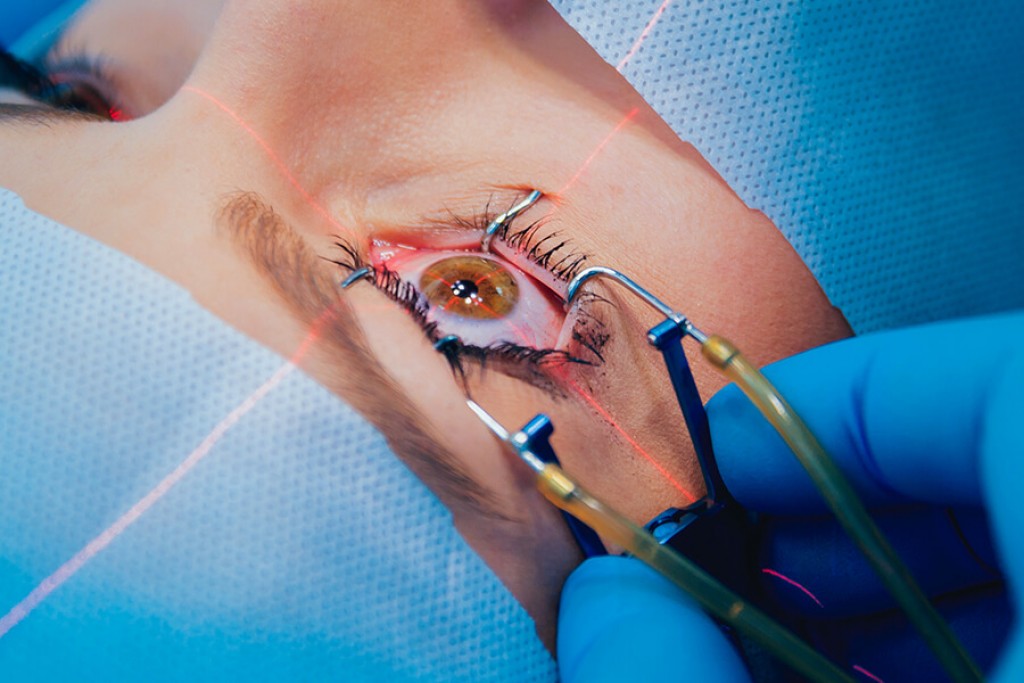 Можно ли бесплатно попасть на операцию по лазерной коррекции зрения