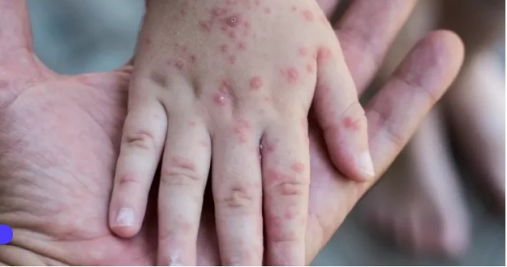 В Карагандинской области ситуация с корью остаётся напряженной