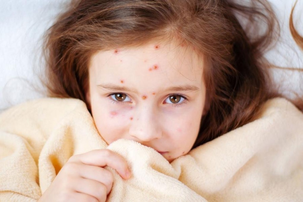 В Карагандинской области пока нет оснований для введения карантина из-за кори