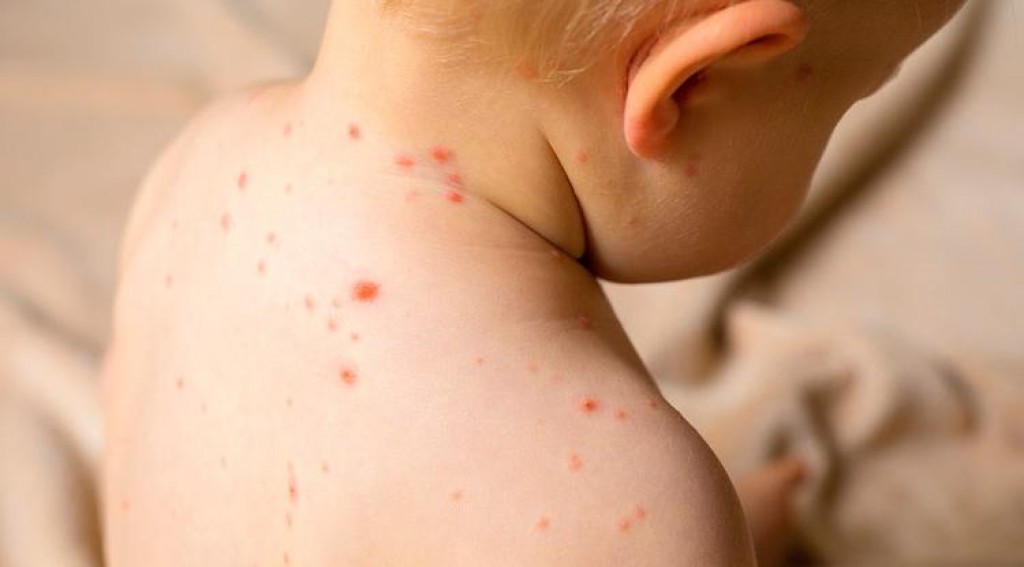 В прошлом году в Карагандинской области прививку от кори не стали делать 120 человек