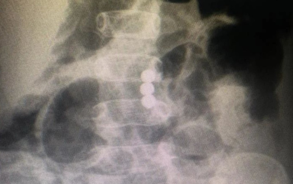 В Балхаше двухлетнему мальчику, проглотившему три магнита, врачи спасли жизнь