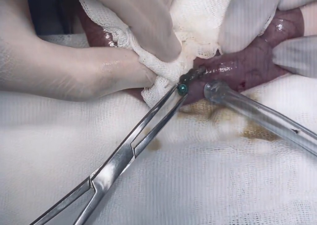 Пять магнитов достали карагандинские врачи из кишечника ребенка