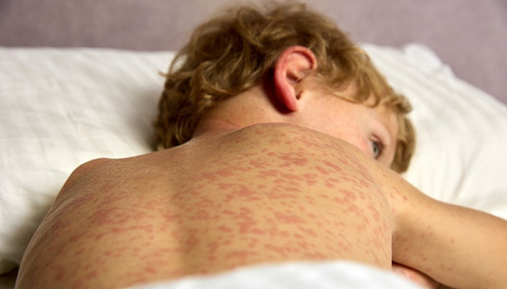 Ситуация усложняется: новые случаи кори зарегистрированы в июне в Карагандинской области