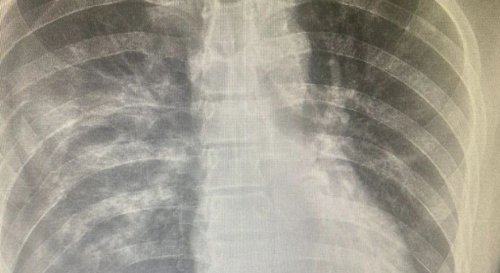 Мужчину с тяжелой производственной травмой спасли врачи Балхаша