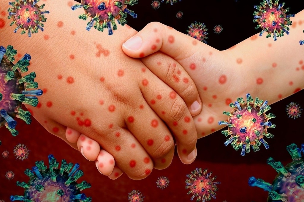 За первые дни января в Карагандинской области зафиксировано 17 заболевших корью