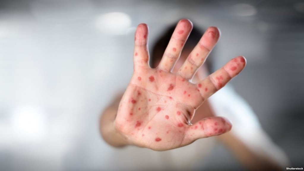 276 человек заболели корью в Карагандинской области с начала февраля