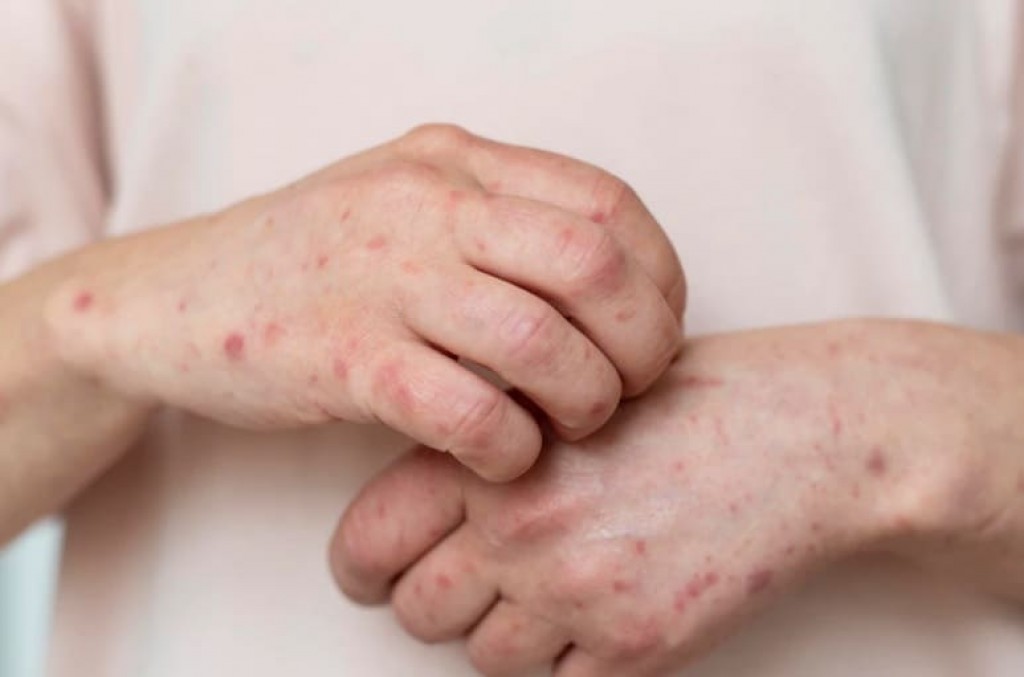 В Караганде регистрируют новые случаи кори