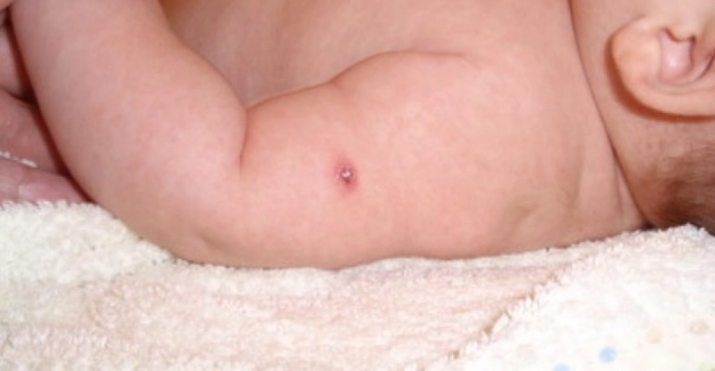 В Караганде физиопедиатр ответит на вопросы по поводу вакцинации прививкой БЦЖ