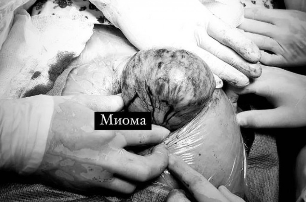 В Караганде беременной женщине провели операцию по удалению миоматозного узла