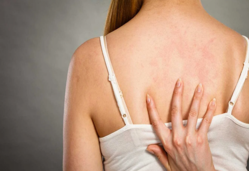 Сыпь на теле после купания в Федоровском водохранилище Караганды: соответствует ли вода нормам?