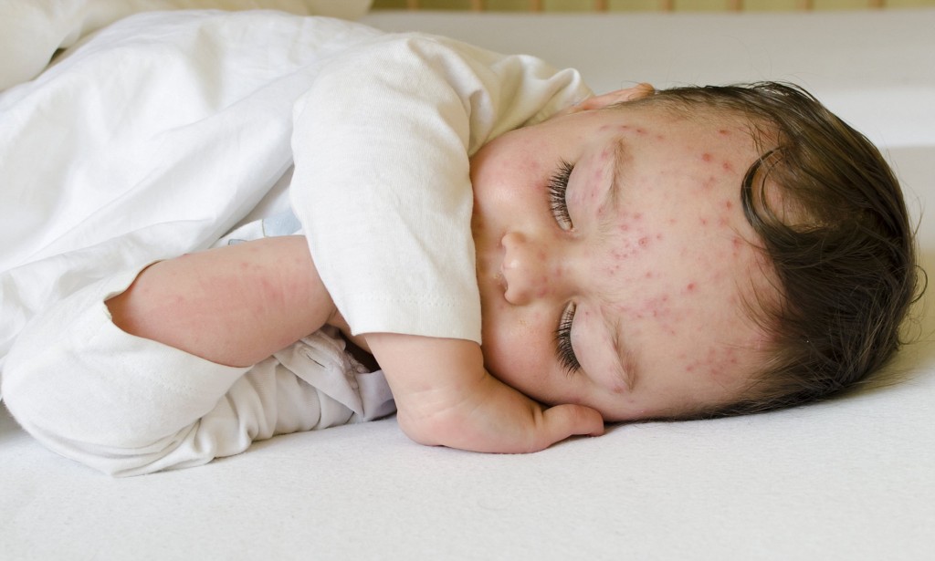 Медицинские организации Карагандинской области перешли на усиленный режим работы из-за повышения заболеваемости корью