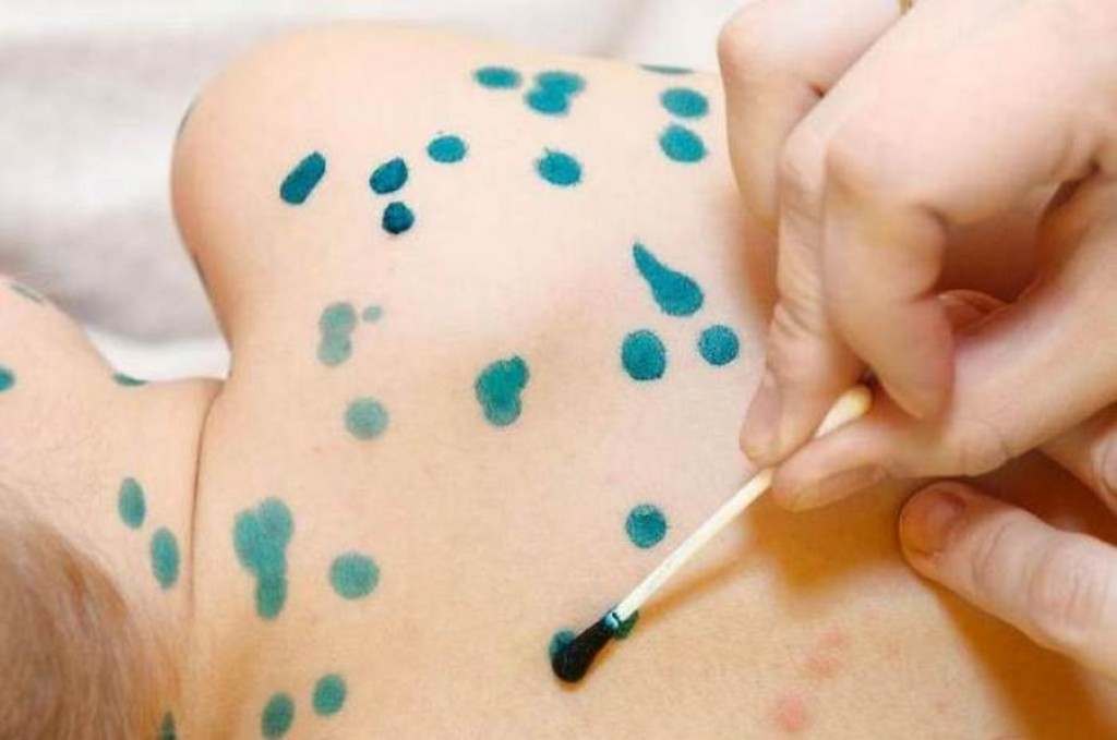 За последние 5 лет заболеваемость ветряной оспой в Карагандинской области снижается