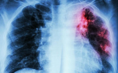В Карагандинской области стартует месячник по профилактике туберкулеза