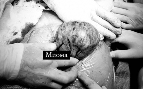 В Караганде беременной женщине провели операцию по удалению миоматозного узла